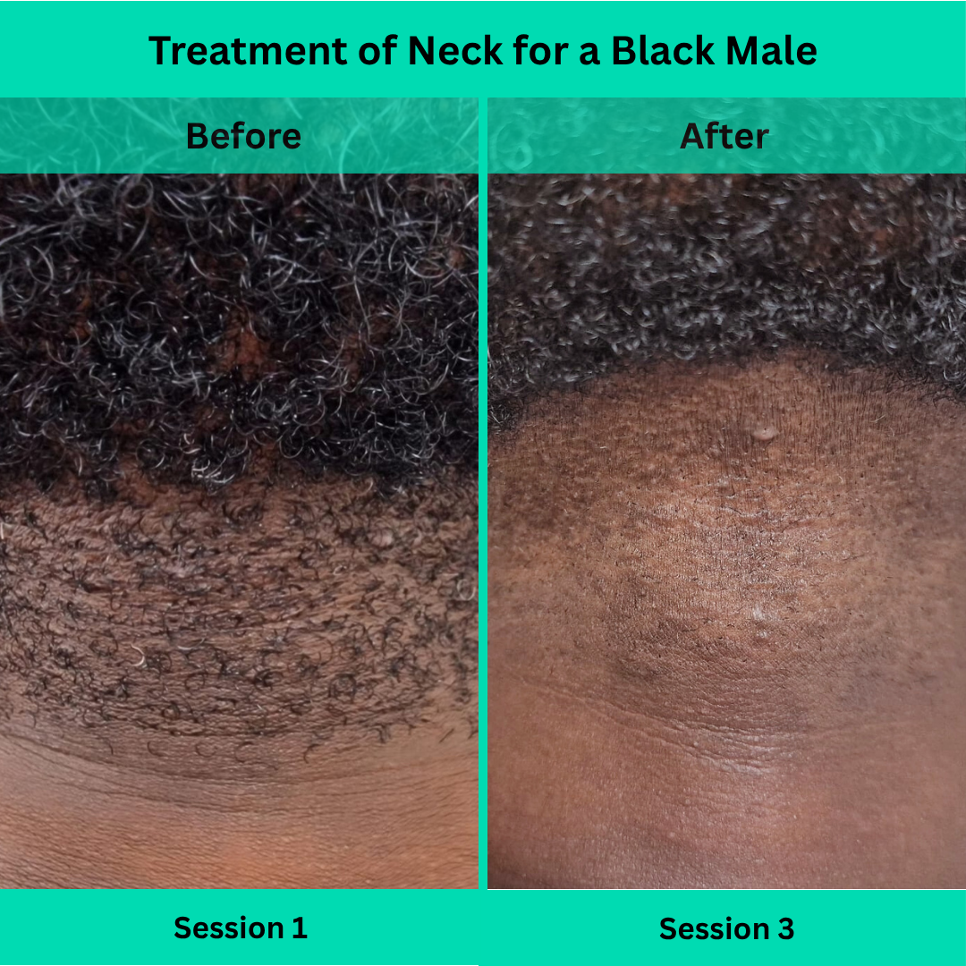 Before and After picture of Laser Hair Removal Treatment of Neck for a Black Male